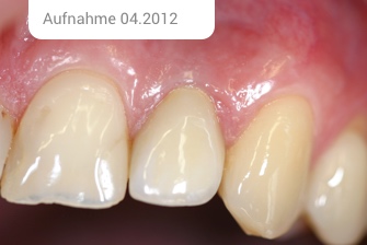 Kollegen Frontzahnimplantat
