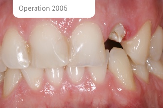 Kollegen Implantat Op 2005 3