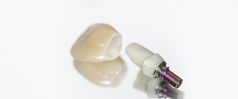 Zahnarzt implantat