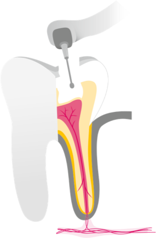 Wurzelkanalbehandlung 2