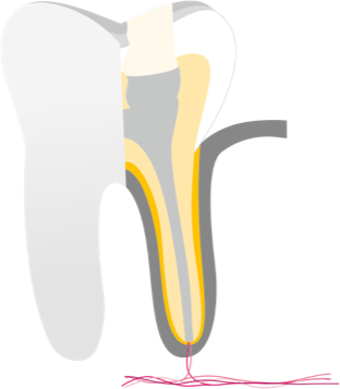 Wurzelkanalbehandlung 4