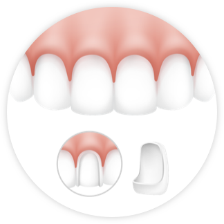 Veneers Grafik 01