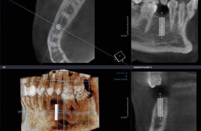 Dvt Implantologie