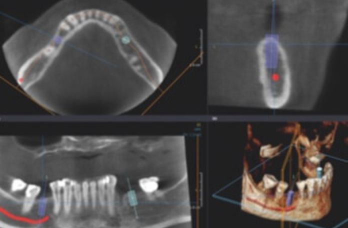 Dvt Implantologie 2