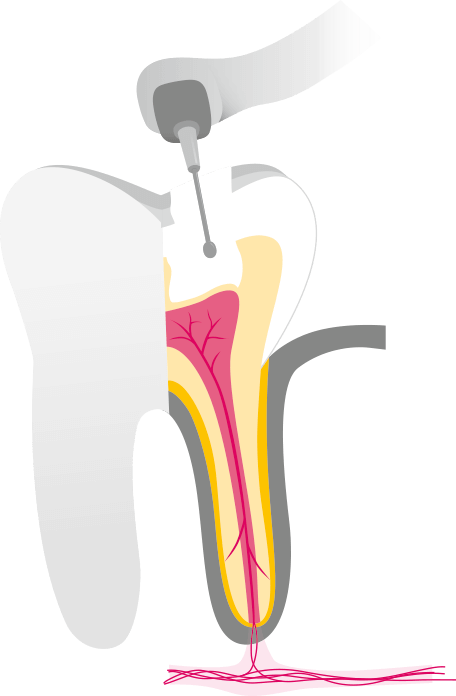 Endo Ablauf 2